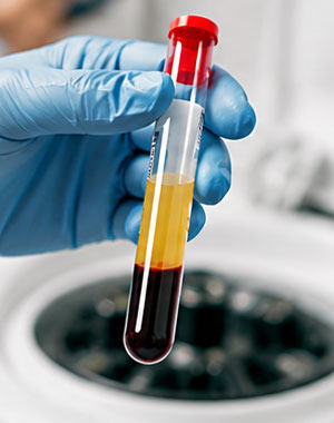 Platelet-Rich Plasma